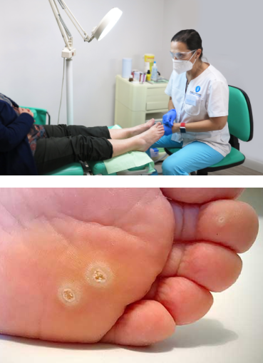 Tratamiento de papilomas plantares