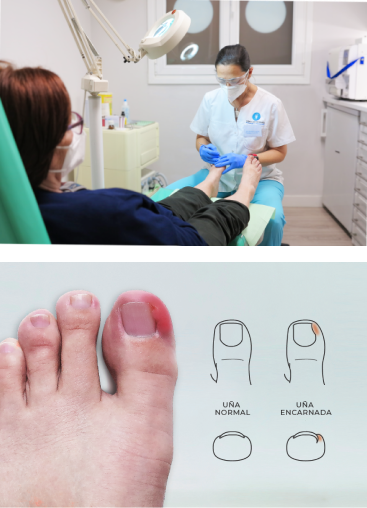Tratamiento de uña encarnada